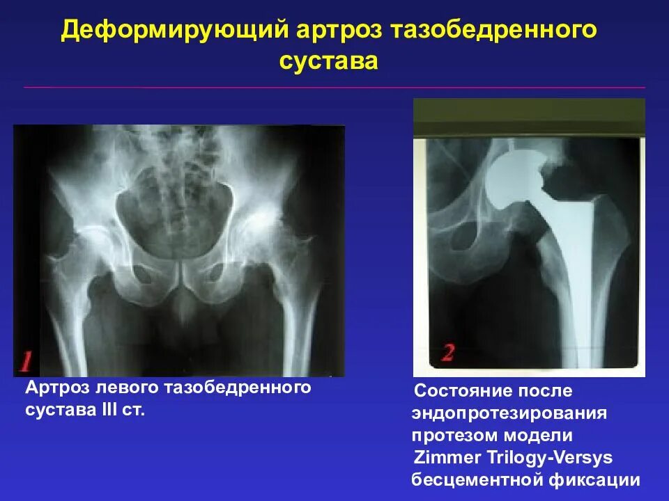 Артрит артроз тазобедренных суставов. Деформирующий артроз тазобедренного сустава 1 степени. Рентген коксартроза тазобедренного сустава 3 степени. Артроз тазобедренного сустава 1 на рентгене. Деформирующий остеоартроз рентген тазобедренного сустава.