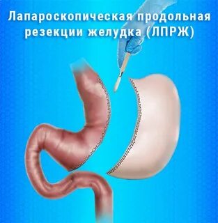 Резекция желудка для похудения последствия