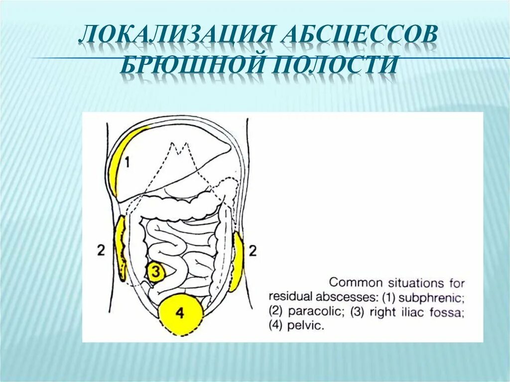 Локализация абсцессов брюшной полости. Абсцессы брюшной полости классификация. Локализация гнойников в брюшной полости. Наличие гноя в брюшной полости