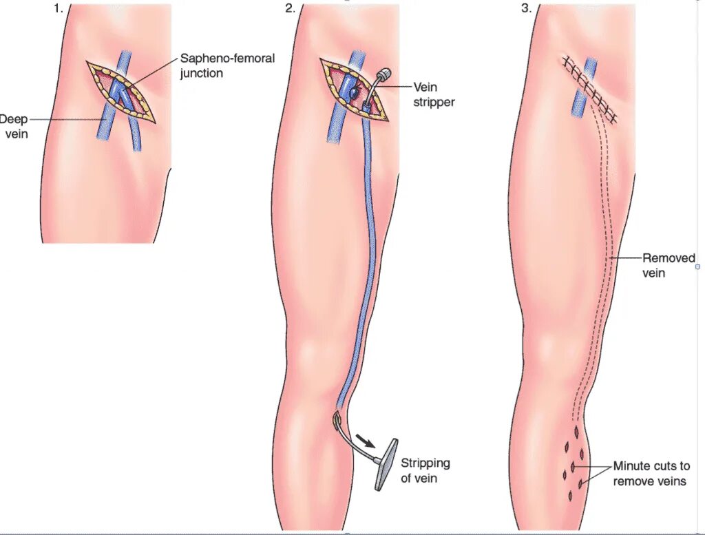 Кроссэктомия Троянова Тренделенбурга. Флебэктомия ход операции хирургия. Тромбоз бпв