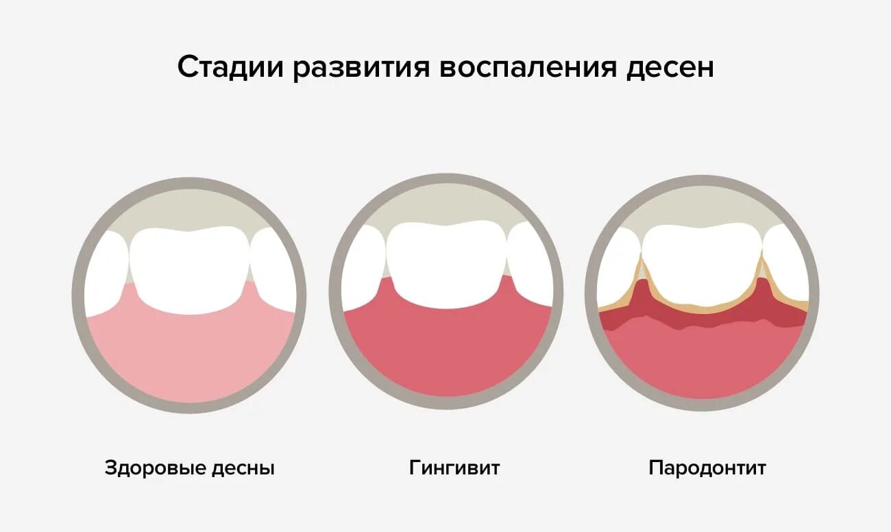 Гингивит у детей как выглядит Periodontitis Зображення - огляд 16,900 Стокові фото, векторні зображення й віде
