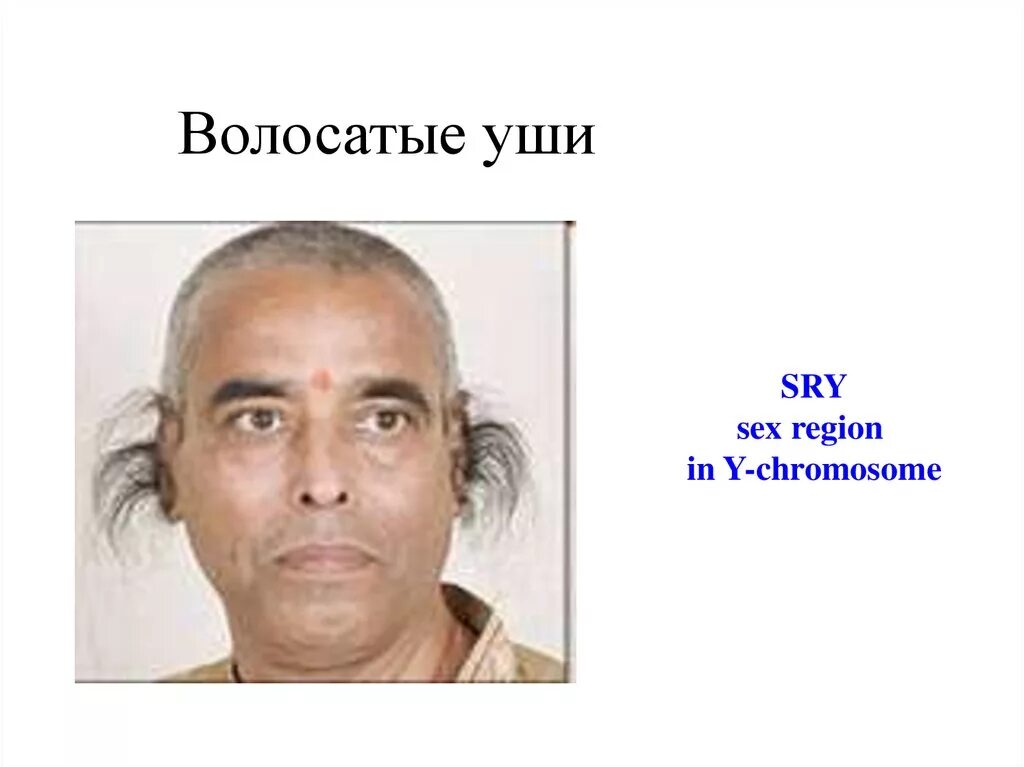 Очень длинные ресницы. Проколы ушей у знаменитостей. Лохматые уши. Посттравматический гипертрихоз. Гипертрихоз ушной раковины.