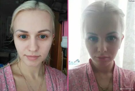 Ринопластика / Пластика носа - "Очень жалею! ....что не сделала этого раньше)) О