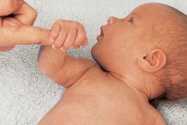 Рефлекс сосания. Хоботковый рефлекс у новорожденных. Ладонно ротовой рефлекс у новорожденных. Ладонно-ротовой рефлекс Бабкина у новорожденных. Хватательный рефлекс у новорожденных (рефлекс Робинсона).