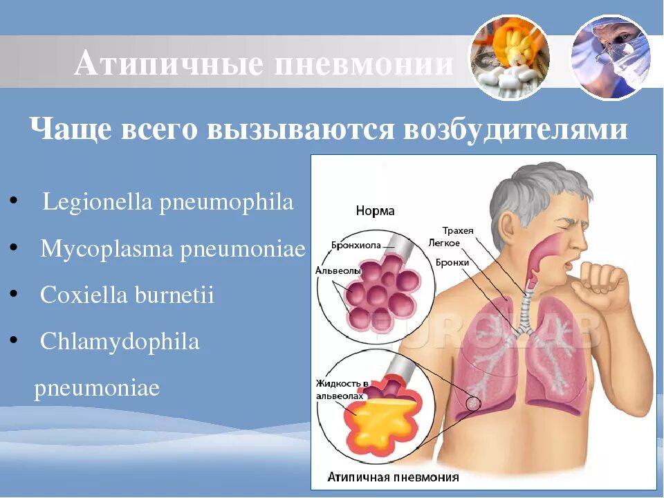 Пневмония при ковиде симптомы. Атипичная пневмония. атипичной пневмонии. симптомы атипичной пневмонии. атипичные пневмонии вызываются.