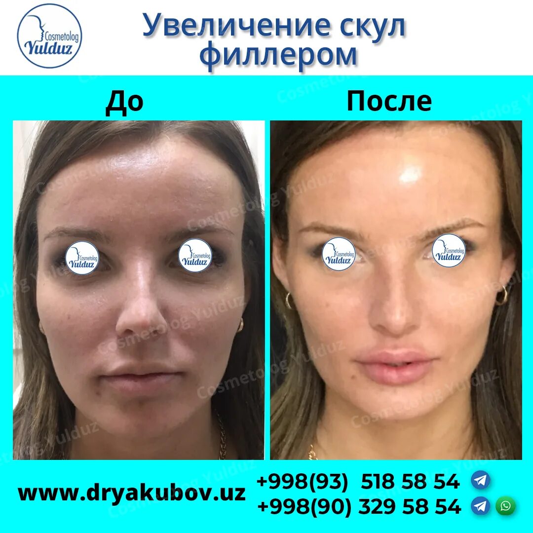 Увеличение сходить. Отек после увеличения губ. Отек после увеличения губ. Увеличение объема продаж. Увеличение сходить.