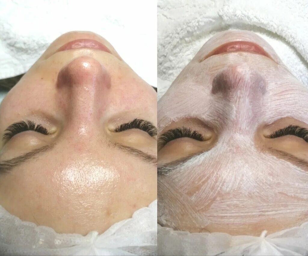 пилинг лица воронеж. чистка лица. уходовые процедуры для лица. пилинг лица воронеж. карбокситерапия безинъекционная.