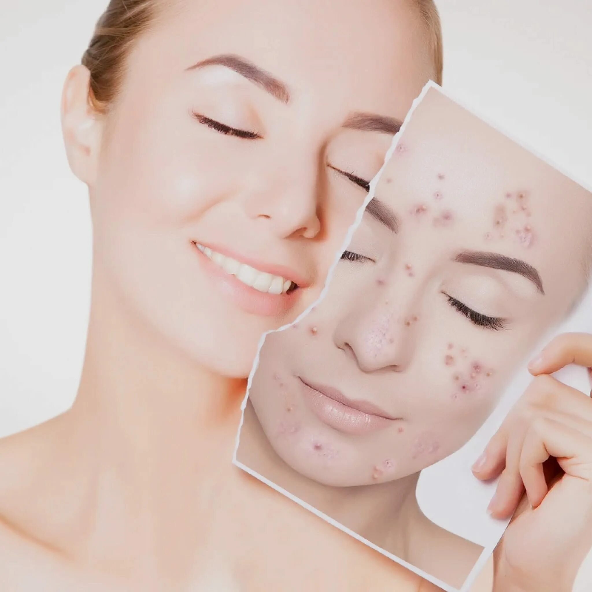 Acne program