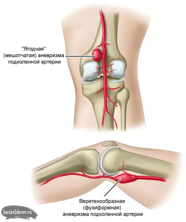 Ноющая боль в коленном. Аневризм подколенной артерии. Аневризма подколенной вены. Сустав колена болит сбоку внутренней стороны. Аневризма подколенной вены операция.