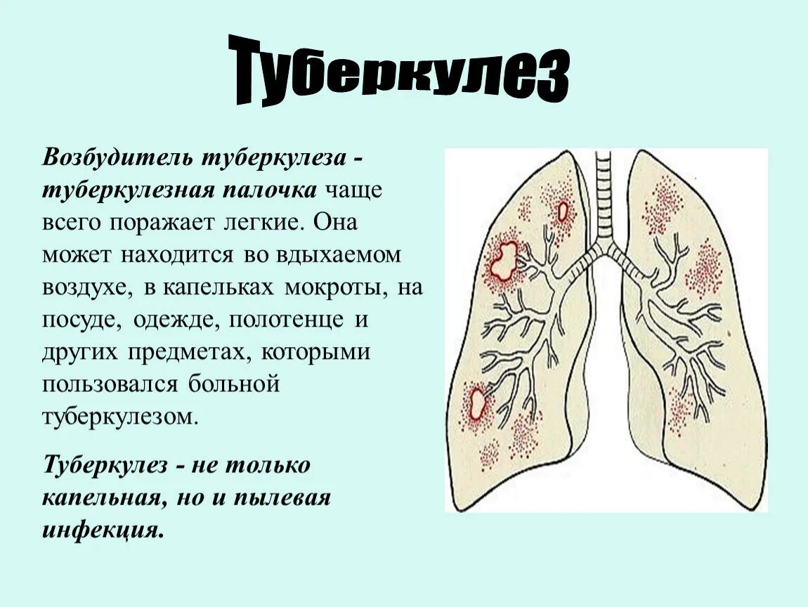 Легочная язва. Туберкулез название заболевания. Поражение органов туберкулезом.