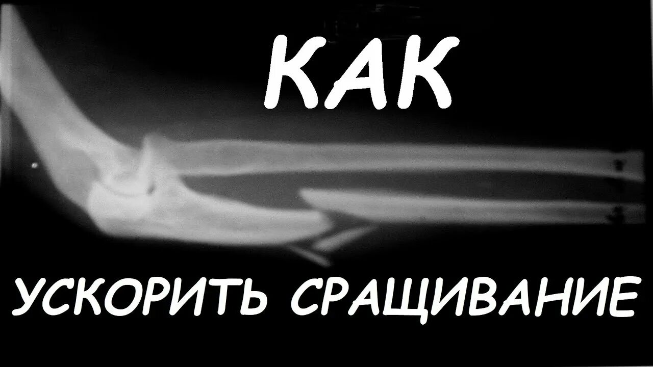 Костная мозоль при переломе. Срастание кости после перелома. Эндостальная костная мозоль. Стадии сращения переломов костей. Стадии сращения переломов костей.