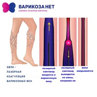 Облитерация это