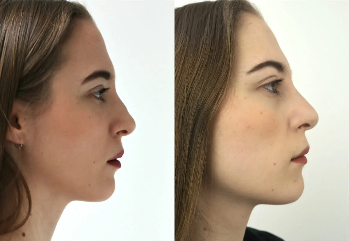 Нос после ковида. Nose Surgery before after. Rhinoplasty before and after. Модный аккуратненький нос после на пластике.