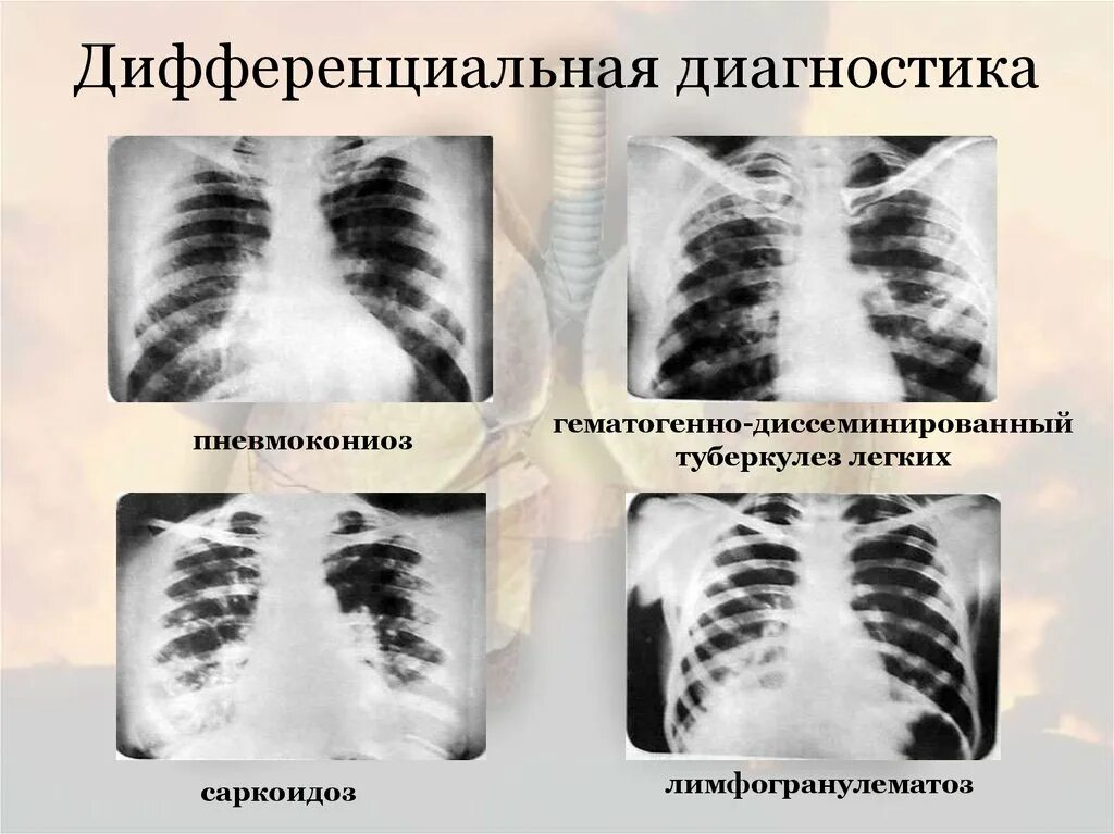 Гематогенно-диссеминированный туберкулез легких. Диссеминированный туберкулез дифференциальный диагноз. Саркоидоз туберкулез дифференциальная. Диссеминированный туберкулез легких дифф. Диагноз с 2 легкого