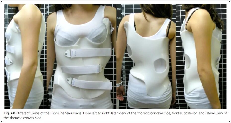 Сколиоз корсет шено. Корсет шено для позвоночника. Корсет шено сколиоз 2 степени. Корсет эббота-шено. Как носить корсет шено.