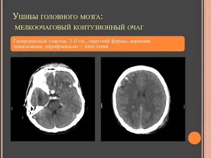 Размер очагов в головном мозге