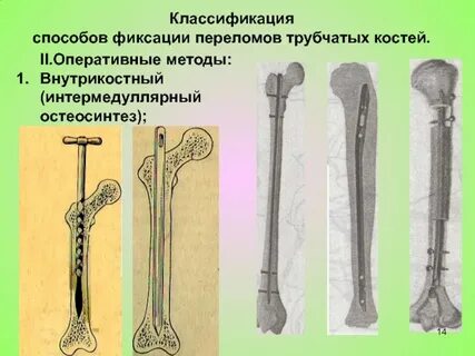Перелом трубчатых костей
