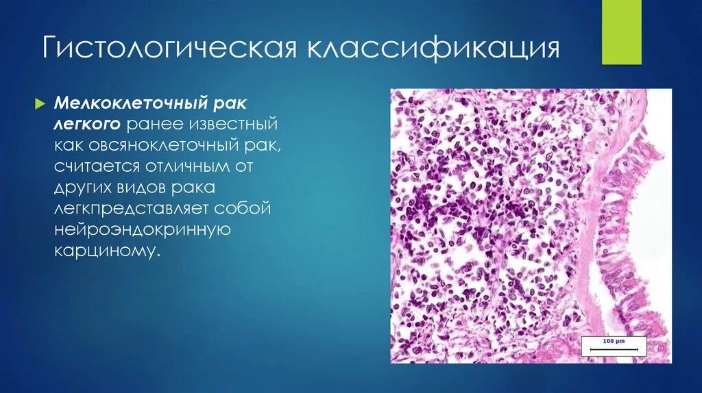 Немелкоклеточная карцинома легкого гистология. Мелкоклеточная карцинома легкого микропрепарат. Нейроэндокринная карцинома макропрепарат легкого. Аденокарцинома бронха гистология. Лечение мелкоклеточного рака