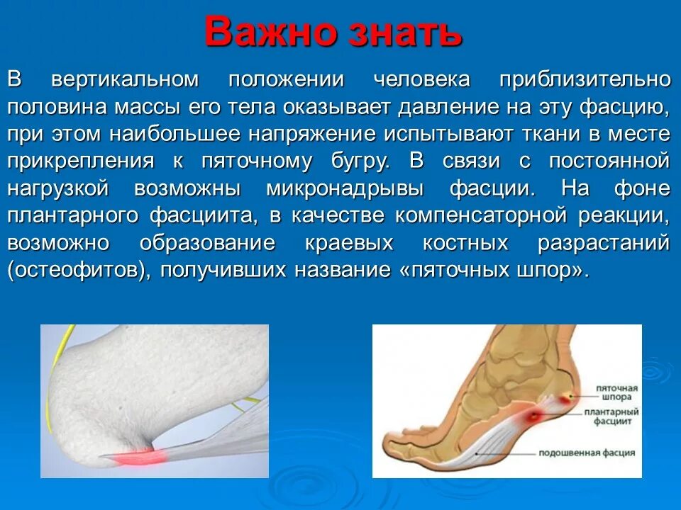 пяточная шпора и подошвенный фасциит. больница пяточная шпора. увт ударно волновая пяточной шпоры. ударно-волновая терапия пяточной шпоры. пяточная шпора плантарный фасциит.
