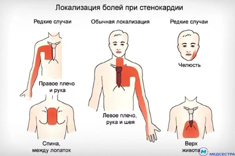 Почему больно какая. Стенокардия напряжения локализация боли. Локализация боли при стенокардии напряжения. Типичная локализация боли при приступе стенокардии. Стенокардия ПМП.