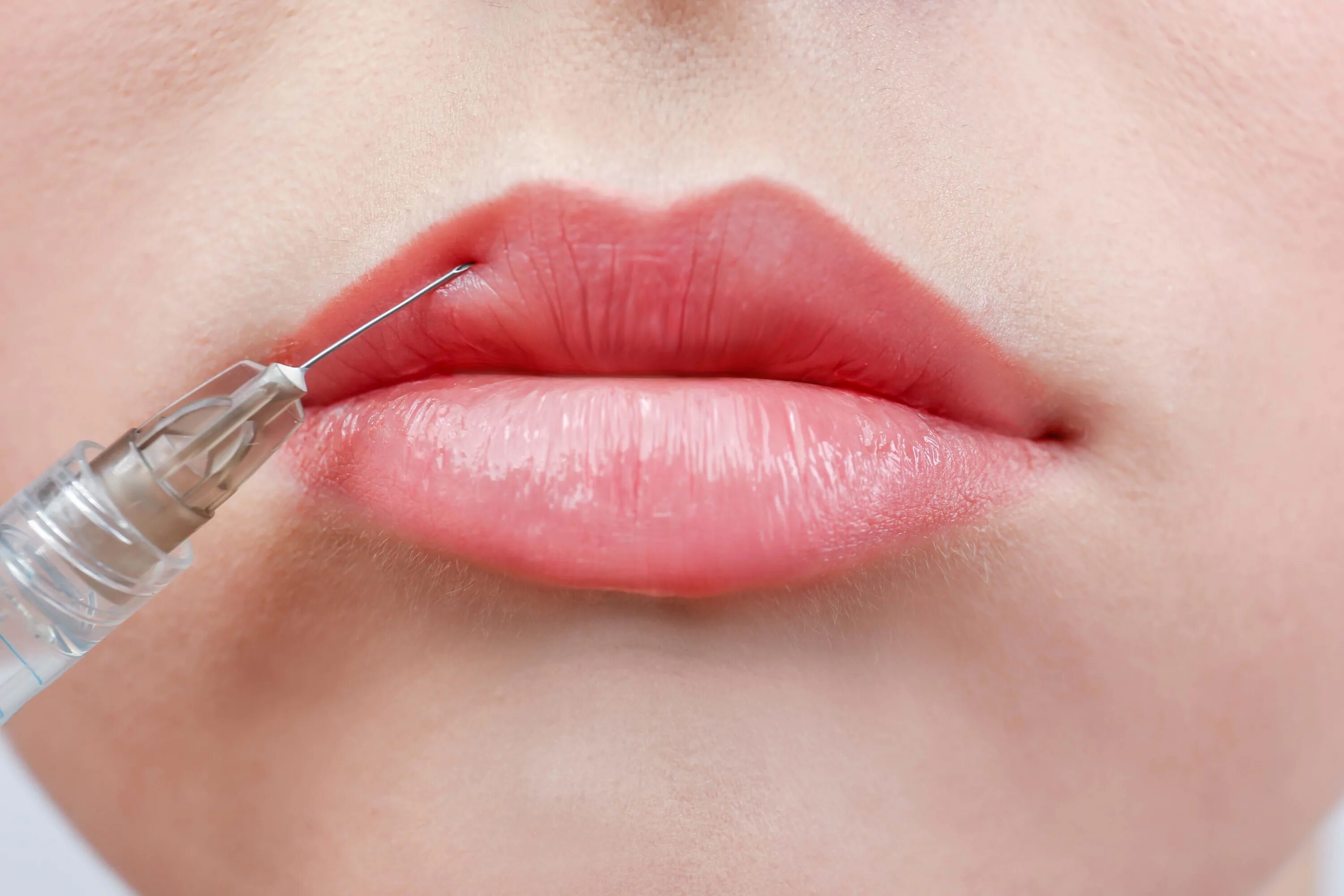 Lip filler