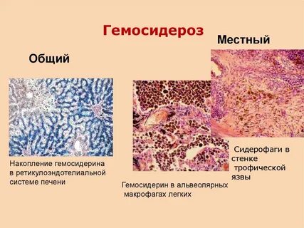 Гемосидероз это