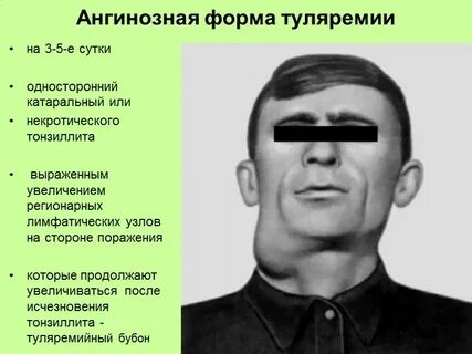 Туляремия симптомы и лечение у взрослых
