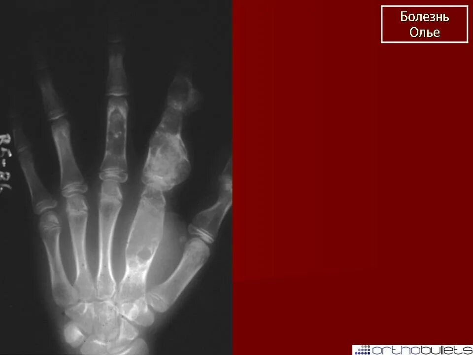 Хондроматоз костей (болезнь оллье). Альбуминозный остеомиелит оллье рентгенография. Болезнь олье. Болезнь олье. Хондроматоз костей (дисхондроплазия).