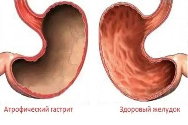 Форум атрофическим гастритом желудка. Хронический атрофический гастрит желудка. Антральный активный гастрит. Атрофический гастрит изменения слизистой. Хронический диффузный атрофический гастрит.