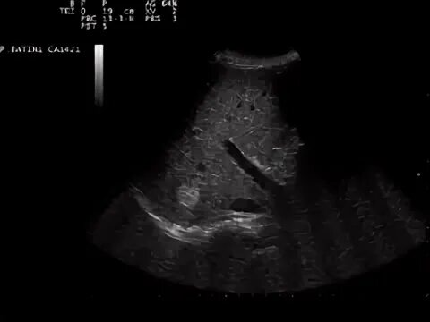 Метастазы в печень мкб. Hepatic Hemangioma Ultrasound examination.