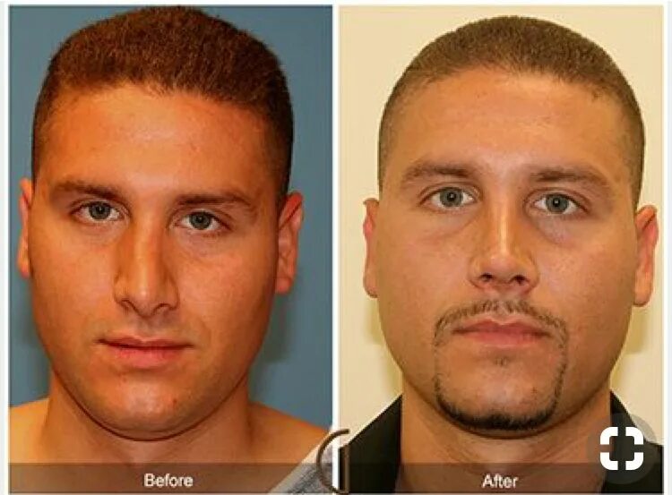 Крупное изменение. Ринопластика до и после мужчины. Нос картошкой ринопластика мужчин. Пластика носа картошкой мужчин.