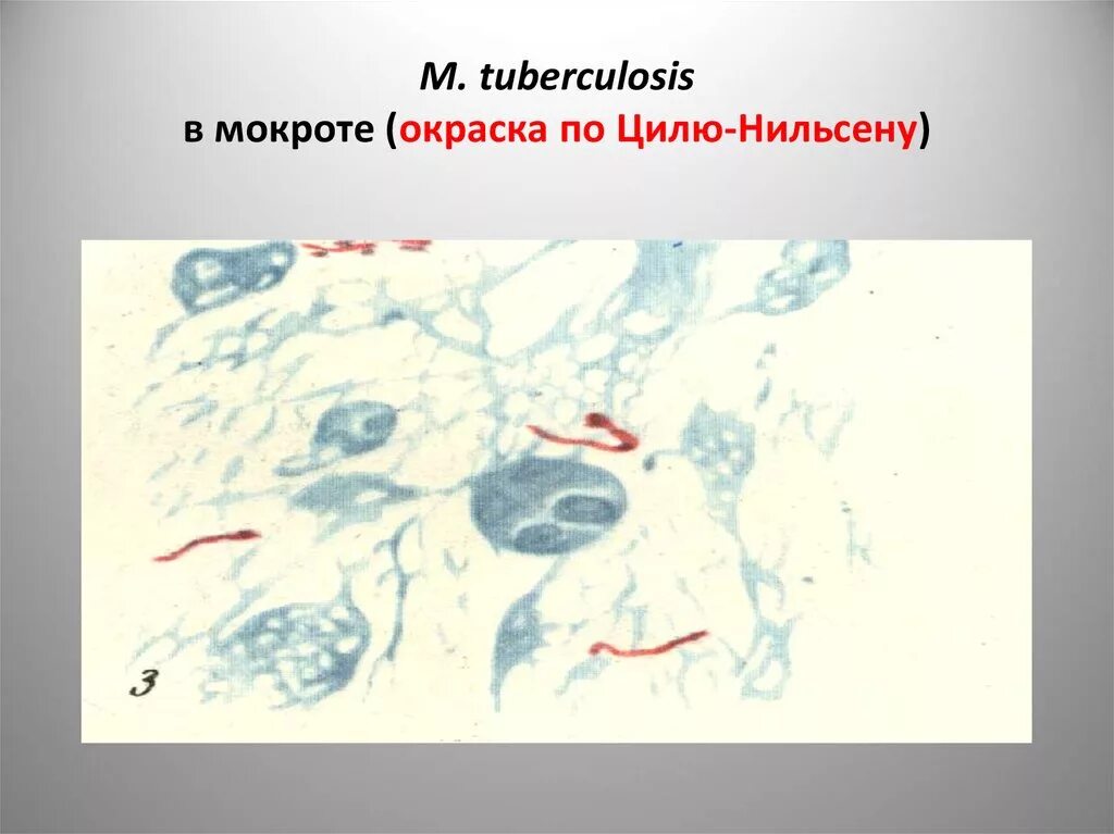 Мокрота по цилю нильсену. Окраска микобактерий по Цилю-Нильсену. Микобактерии туберкулеза окраска по Цилю-Нильсену. Микобактерии туберкулеза по Циля-Нильсена. Микобактерия туберкулеза по Цилю Нильсену.