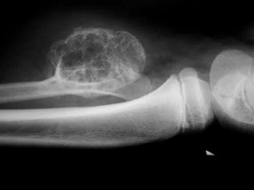 как называется нарост на кости. костно-хрящевой экзостоз малоберцовой кости. как называется нарост на кости. костный экзостоз бедренной кости. экзостоз коленного сустава рентген.