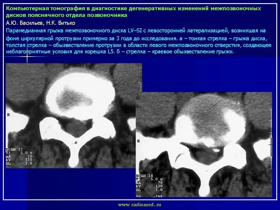 Диффузно дегенеративные. Дегенеративные изменения позвонков кт. Обызвествление диска на кт. Дегенеративные изменения спинного мозга. Дегенеративные изменения позвоночника на кт.