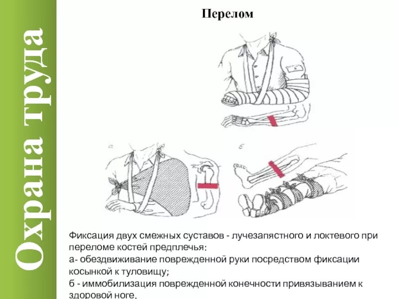 Иммобилизация двух смежных суставов при переломе. Фиксация при переломе предплечья. Фиксация суставов при переломе. При переломе костей предплечья иммобилизируют суставы:.