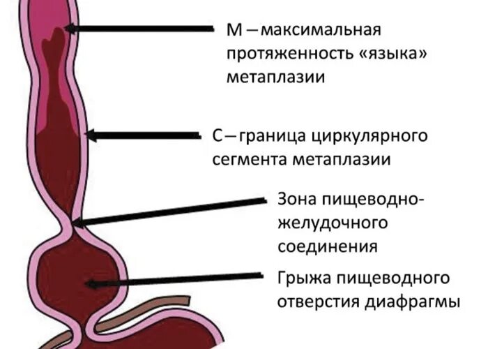 Пищевод баретта