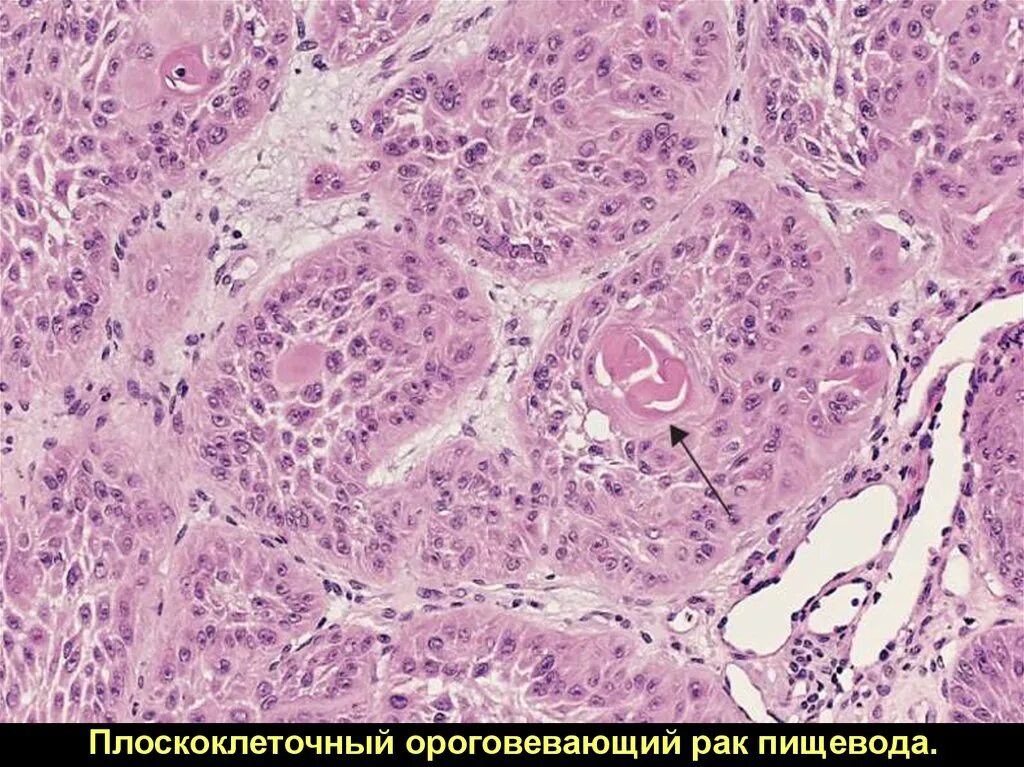 Плоскоклеточными опухолями. Плоскоклеточная папиллома гистология. Базальноклеточная карцинома гистология. Карцинома (плоскоклеточный рак). Плоскоклеточная карцинома гортани гистология.