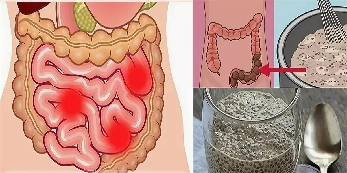 Загрязненный кишечник. Как чистить кишечник в домашних