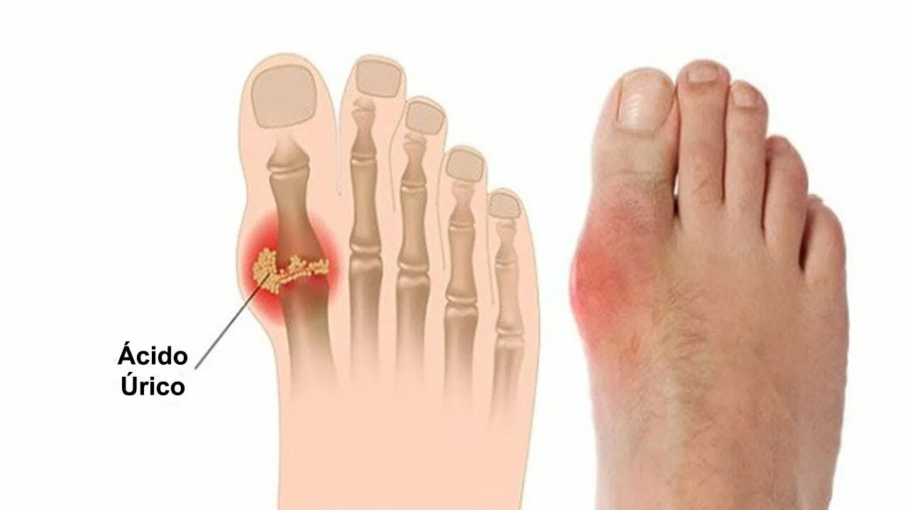 Почему болят суставы больших пальцев. Плюснефаланговый сустав подагра. Подагрический артрит 1 пальца стопы.