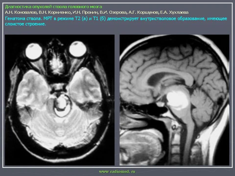 Диффузная опухоль ствола головного мозга. Глиома ствола головного мозга мрт. Опухоль ствола головного мозга мрт. Объемное образование ствола головного мозга. Диагнозы опухоли мозга