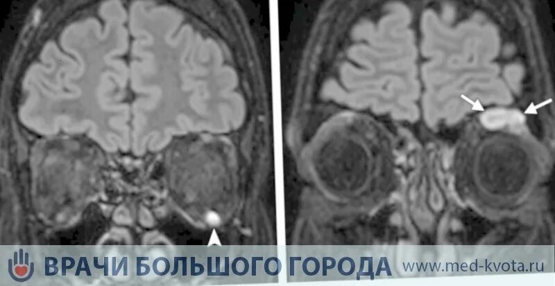 Глиома хиазмы. Глиома хиазмы. Опухоль мозолистого тела кт. Ангиоцентрическая глиома мрт. Глиома зрительного нерва на кт.