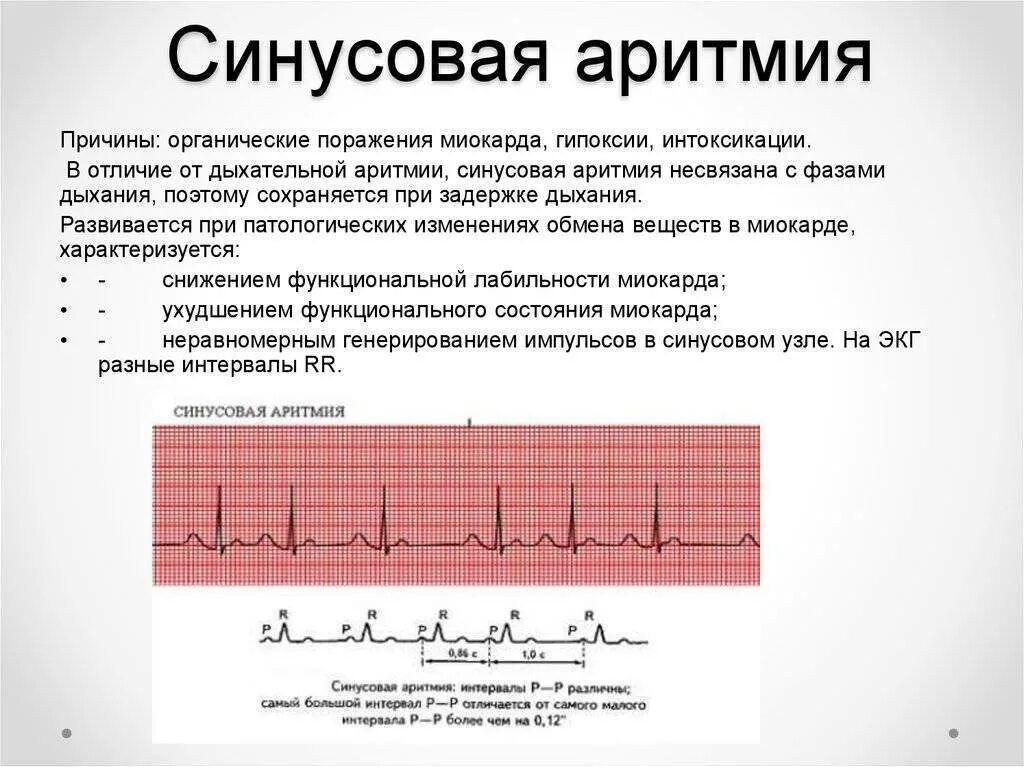 Синусовая аритмия с ЧСС 80-100 уд/мин. Синусовая аритмия на ЭКГ. Лечится ли синусовая аритмия сердца. ЭКГ при нарушениях ритма сердца у детей.