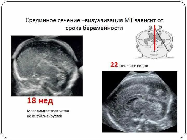 Мозжечок у плода норма. Мозолистое тело у плода на УЗИ. Толщина мозолистого тела у плода. Гипоплазия мозолистого тела УЗИ. Аномалия мозолистого тела.