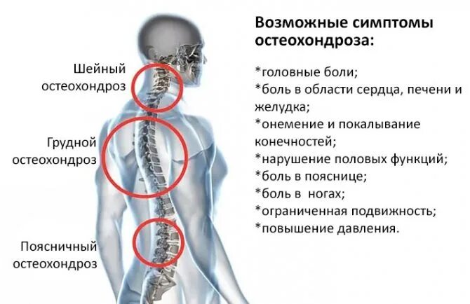 Что может. Остеохондроз шейного отдела симптомы. Симптомы остеохондроза шейного отдела позвоночника. Симптомы хондроза грудного отдела. Хондроз шейного отдела симптомы у мужчин.