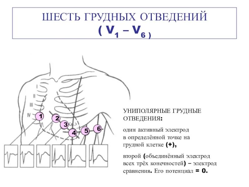 ЭКГ наложение грудных отведений. Отведения v1-v6 на ЭКГ. ЭКГ схема наложения электродов по Вильсону. ЭКГ грудные отведения точки. Отведение v1 на экг