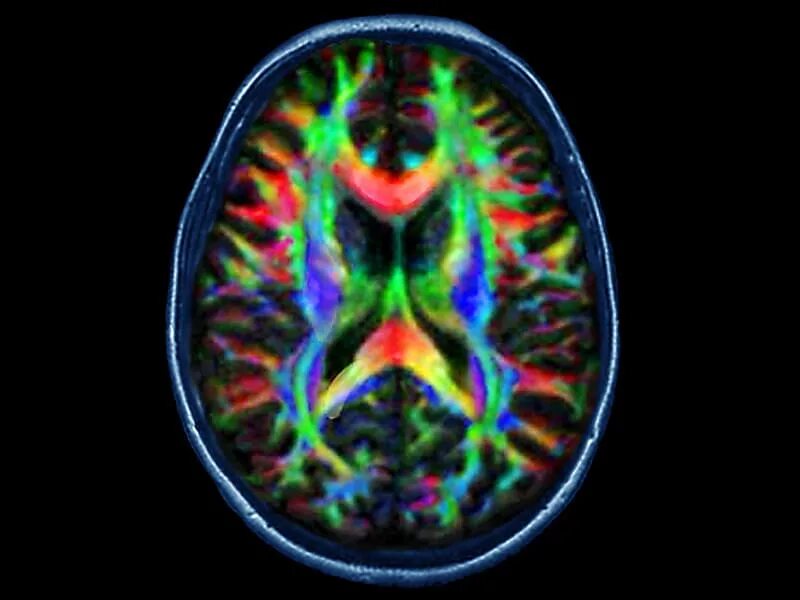 Diffusion tensor. Dti mri. fa carts dti mri. mean diffusion carts dti mri.