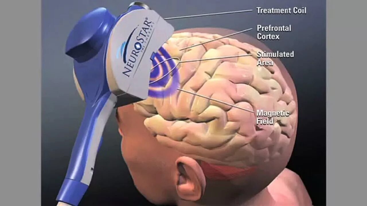 Мозг терапия инструкция. Глубокая стимуляция мозга. ТМС стимуляция мозга. Глубинная стимуляция головного мозга.