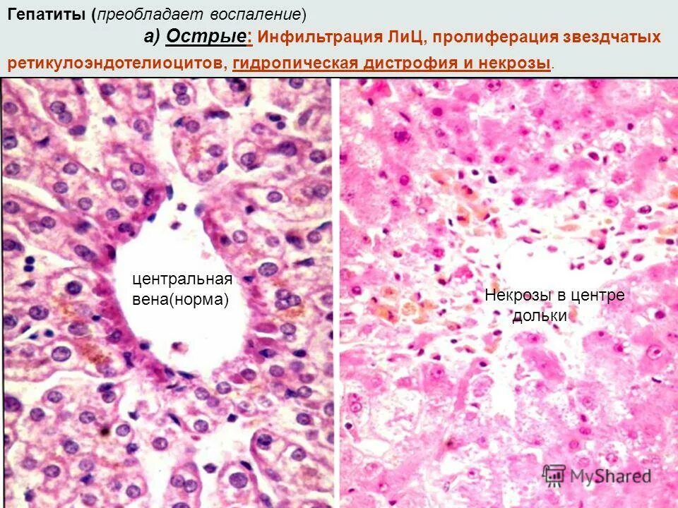 Острая дистрофия печени. Гидропическая дистрофия. Дистрофия гепатоцитов гистология. Гидропическая дистрофия печени. Баллонная дистрофия гепатоцитов.