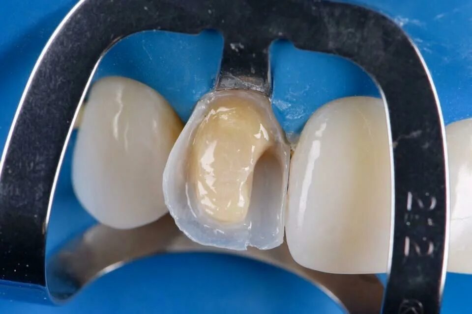 Материал для реставрации зубов. Композитные виниры кариес. Композиты для передних зубов. Пломбирование фронтальных зубов.