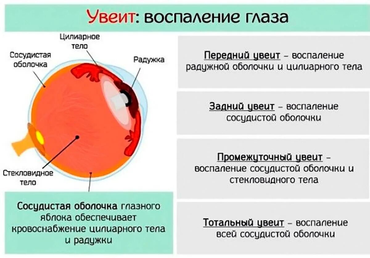 Воспаление сосудистой оболочки глаза. Увеит (воспаление сосудистой оболочки глаза)..